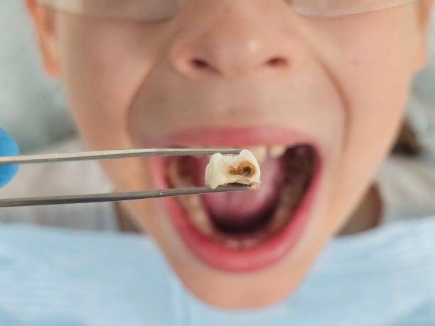 Best Emergency Broken Tooth Repair in Glenmora, LA